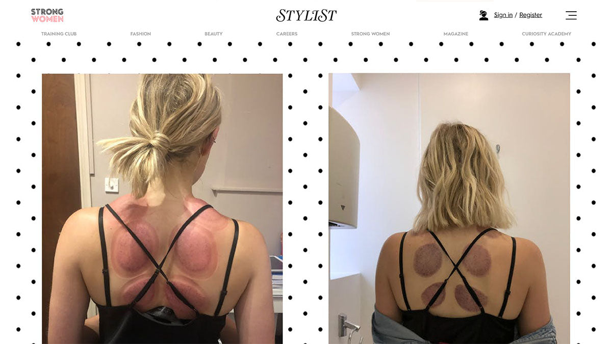 Cupping therapy: is the alternative treatment good for sore muscles?