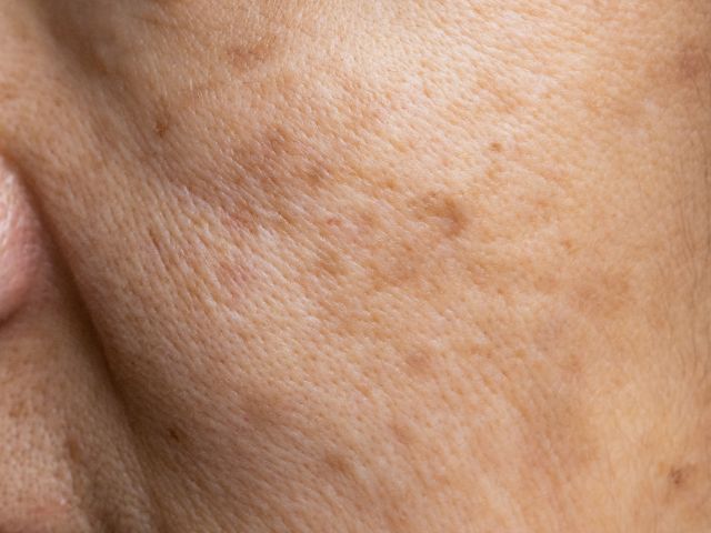 How to Repair and Prevent Sun Damage with Proven Skincare